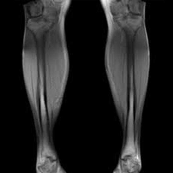 MRI Leg